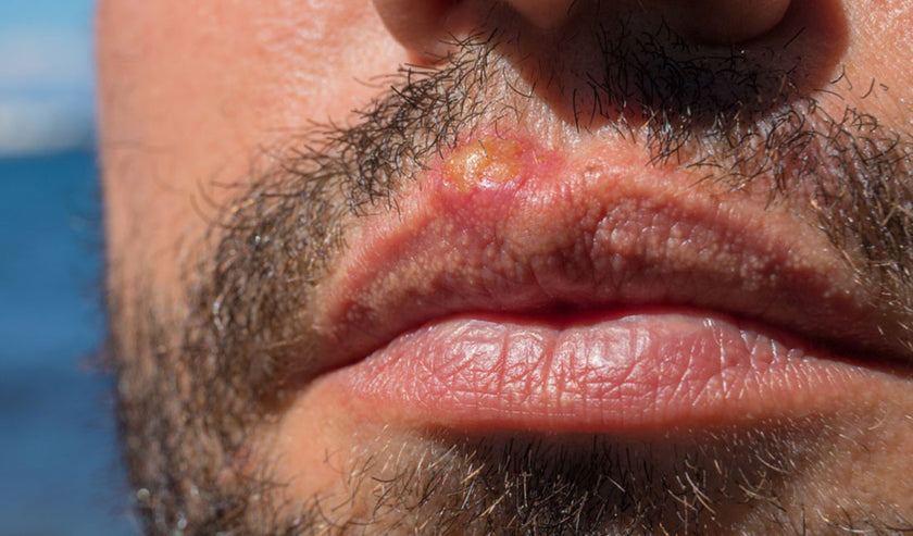 sunburn lips closeup sunburn lips closeup